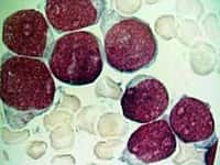 Prolifération maligne clonale de cellules lymphoïdes immatures et bloquées à un stade précoce de leur différenciation (blastes). Pr D. Bordessoule