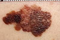 Le mélanome est le cancer de la peau le plus dévastateur, avec un taux de survie à 5 ans de moins de 15% lorsque les métastases sont déjà développées. © Wikimedia Commons