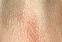 La peau peut être atteinte par de nombreuses maladies, dont l'ichtyose. © Wikimedia Commons