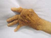 La polyarthrite rhumatoïde est une maladie inflammatoire qui se traduit notamment par une atteinte articulaire, et qui amène à des déformations assez spectaculaires, comme peut en témoigner cette main déformée. © James Heilman, Wikipédia, cc by sa 3.0