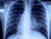 Pour dépister le cancer du poumon précocement, les scanners hélicoïdaux seraient plus efficaces que les radiographies des poumons. © bravajulia/shutterstock.com