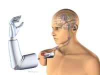 Vue schématisée de la prothèse implantée directement sur l’os du membre amputé grâce à un insert en titane. Les électrodes seront placées sur les nerfs et les muscles restants. © Integrum