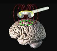 La stimulation magnétique transcranienne (ou TMS, abréviation de l'anglais Transcranial Magnetic Stimulation). © domaine public