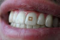 Le capteur dentaire est composé de trois couches et fonctionne comme une étiquette électronique. © SilkLab, Tufts University