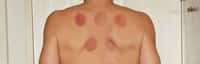 Une séance de cupping peut laisser ces étranges traces non douloureuses, même si elle présente tout de même un danger de lésions cutanées. © pxhere