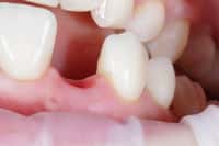 Un médicament pourrait permettre la repousse des dents définitives absentes ou perdues. © leriostereo, Adobe Stock