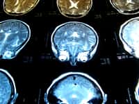 Les médecins peuvent dépister des lésions cérébrales par imagerie par résonance magnétique (IRM). Ces blessures pourraient-elles être réparées grâce à la thérapie génique ? © PhOtOnQuAnTiQuE, Flickr, cc by nc nd 2.0