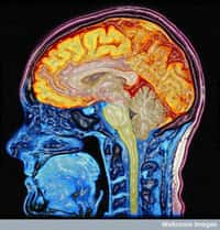 La sclérose en plaques est une maladie auto-immune du système nerveux central, c’est-à-dire le cerveau et la moelle épinière. Elle évolue très lentement et handicape la vie quotidienne 15 à 20 ans après le début des premiers symptômes. © Mark Lythgoe, Chloe Hutton, Wellcome Images, Flickr, cc by nc nd 2.0
