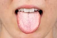 Certains patients atteints de la Covid-19 peuvent présenter des symptômes buccaux, notamment sur la langue. © Alessandro Grandini, Adobe Stock