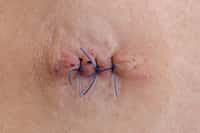 De nos jours, les points de suture sont utilisés pour réparer&nbsp;une blessure profonde. Des chercheurs proposent des alternatives, mais les points de suture seront toujours parfois nécessaires. © bmf-foto.de, Fotolia