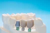 Le prothésiste dentaire réalise des prothèses et orthèse à la demande d'un professionnel de santé. Il travaille au cas par cas et fait uniquement du sur-mesure. © sujit, Adobe Stock.