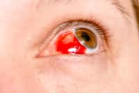 Une tache de sang dans l’œil est la plupart du temps bénigne et se guérit spontanément. © haoka, Fotolia