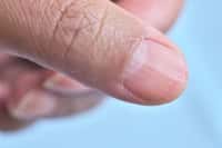 Une mutation génétique rare fait disparaître les ongles, partiellement ou en totalité, des personnes touchées. © naowarat, Adobe Stock