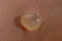 Cette petite bulle, la cloque, peut se former pour mille et une raisons. Elle contient souvent du plasma sanguin mais peut aussi se remplir de pus, un liquide composé de cellules de l'immunité et de tissus morts. © Frazzmatazz, Wikipédia, cc by sa 3.0