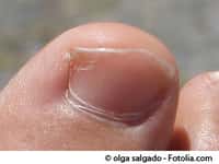 Les ongles jaunis ou brunis sont souvent la conséquence d'une infection par un champignon. N'attendez pas pour consulter un médecin. © Olga Salgado/Fotolia