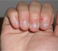 Il existe des solutions pour arrêter de se ronger les ongles. © DR