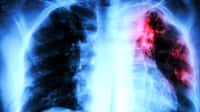 La tuberculose reste une maladie très présente en France