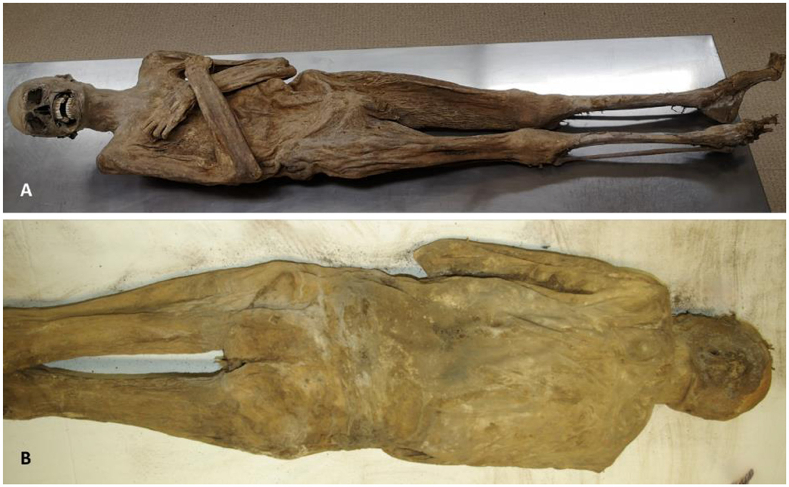 Il ne faut pas se fier à l’aspect inquiétant de la momie de St Thomas am Basenstein : elle est un formidable sujet d’étude pour les légistes qui tentent encore aujourd’hui de percer ses secrets. © A. N’éplucha