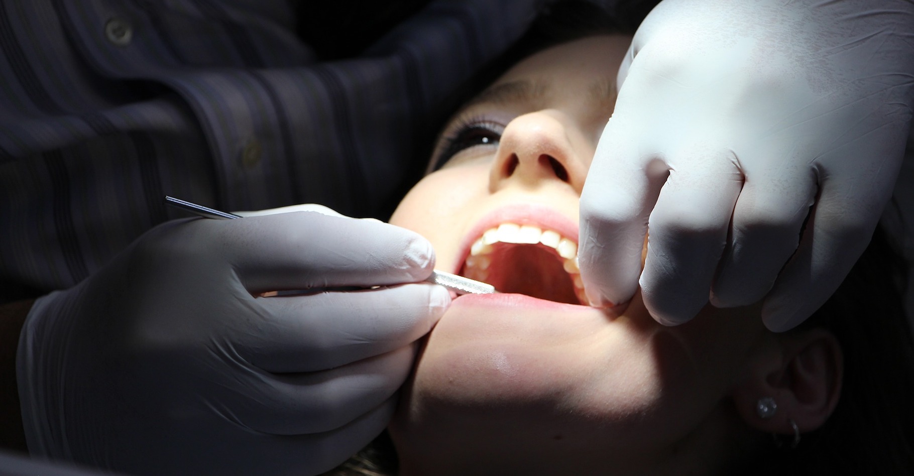 Le terme amalgame est notamment connu dans le secteur de la dentisterie où il désigne un matériau utilisé pour combler les trous laissés dans les dents après élimination de caries. © rgerber, Pixabay, DP