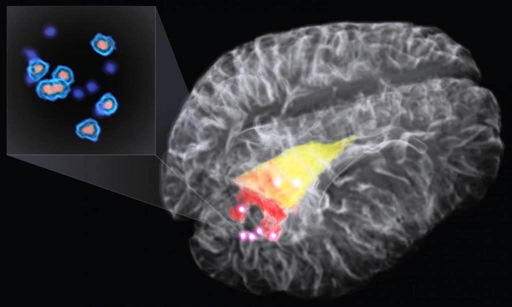 Une illustration de la méthode mise au point par des chercheurs canadiens pour repérer dans le cerveau des cellules cancéreuses. Elle exploite l'effet Raman avec un laser. © Science Translational Medicine, Petrecca K., Leblond F. et al.