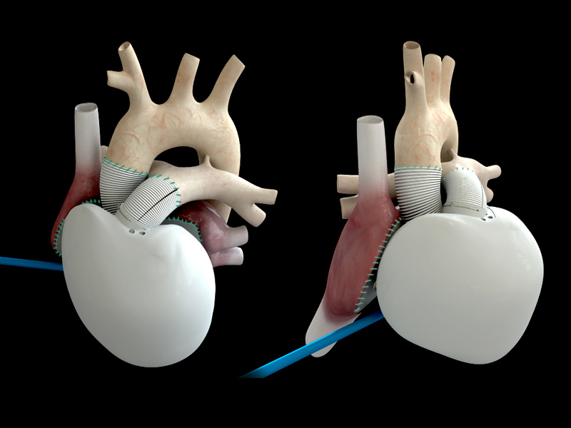 Le 18 décembre, un patient a enfin été équipé du cœur artificiel Carmat, le premier cœur artificiel total. Il devrait prochainement être implanté chez d'autres personnes en insuffisance cardiaque et pourrait être commercialisé d'ici deux à cinq ans. © Carmat