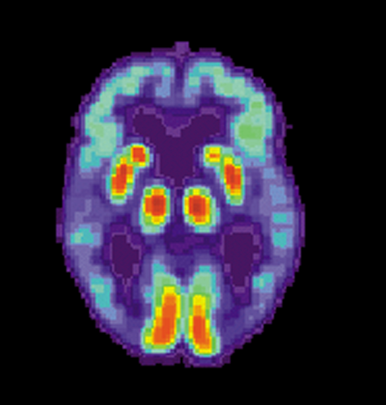 Cerveau d’un patient souffrant d’Alzheimer observé par TEP (tomographie par émission de positons) © US National Institute on Aging, Alzheimer's Disease Education and Referral Center, administration américaine, DP