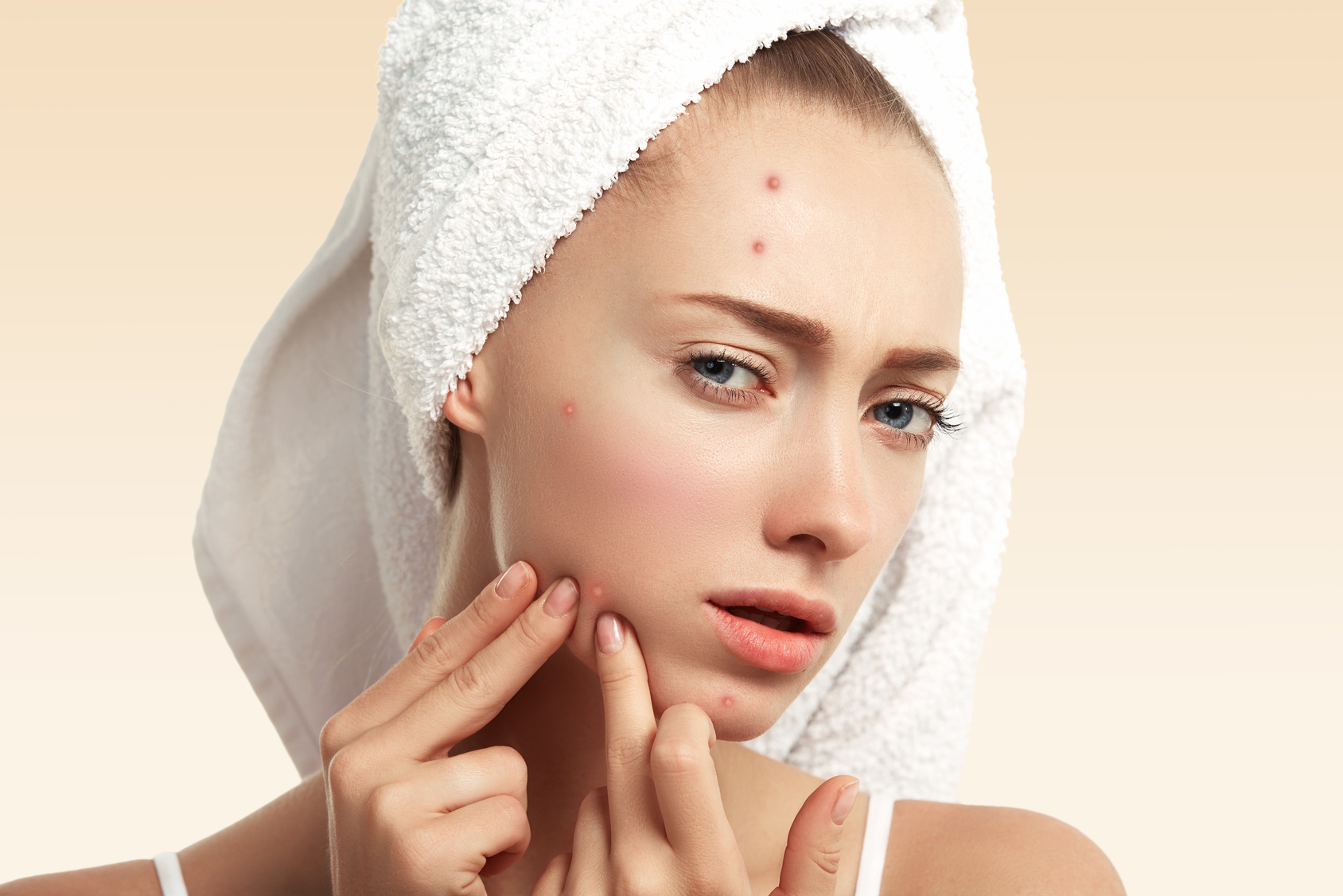 De plus en plus d'adulte sont touchés par l'acné. © Wayhome Studio, fotolia