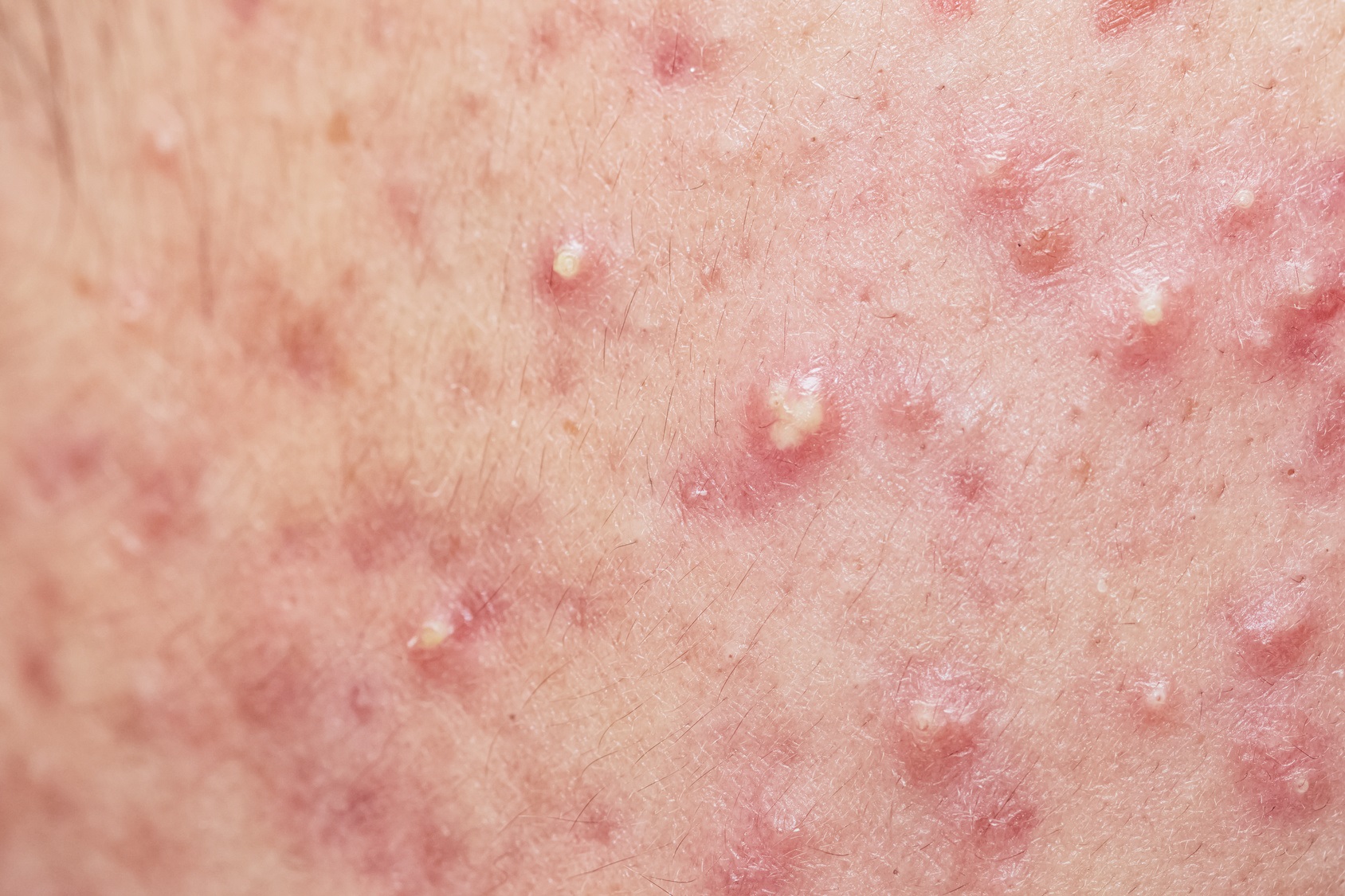 L'acné provoque&nbsp;des boutons sur le visage, le thorax ou le dos. © Praisaeng, Fotolia
