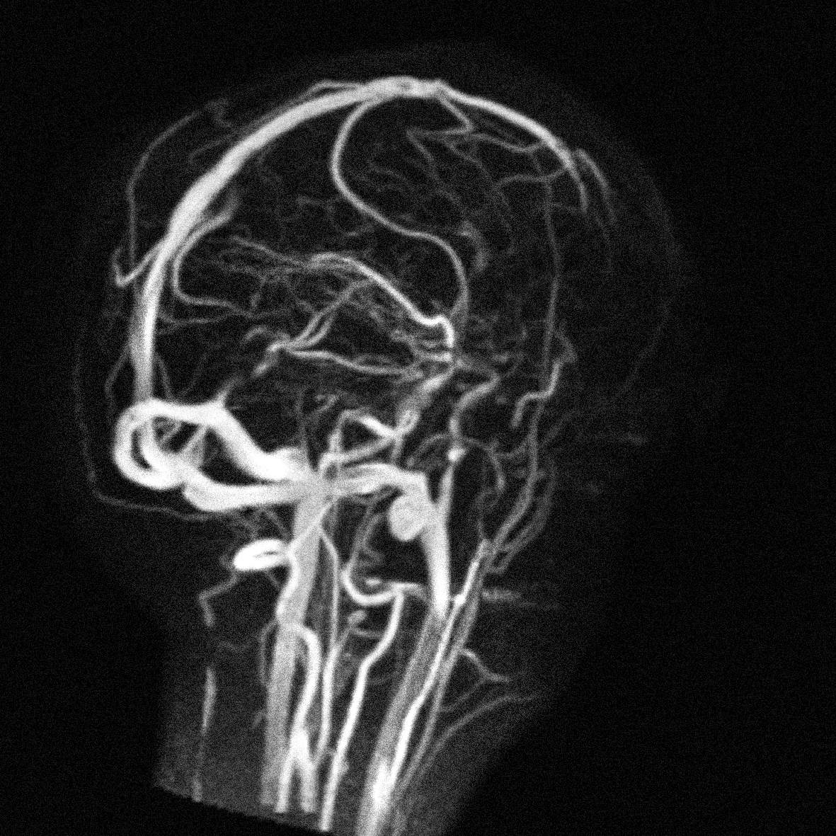 L'IRM peut être très précise. Ainsi, cette image montre l'ensemble des vaisseaux sanguins irriguant le crâne et le cerveau.&nbsp;©&nbsp;IR4M – CNRS – Université Paris-Sud
