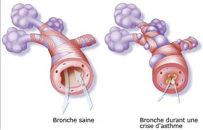 Une bronche (à gauche), un canal qui conduit l'air aux alvéoles pulmonaires, peut se boucher complètement sous l'effet d'une réaction allergique : c'est la crise d'asthme (à droite) © Resedaa