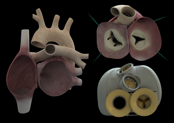Le premier cœur artificiel total, capable de s'adapter à la vie de son porteur, a été implanté chez un patient le 18 décembre 2013. Les deux ventricules (à droite) sont greffés sur les oreillettes (à gauche). Le matériau dont il est constitué le rend biocompatible. Le premier patient chez qui il a été installé est décédé 74 jours après l'opération. Les causes sont actuellement recherchées. © Carmat