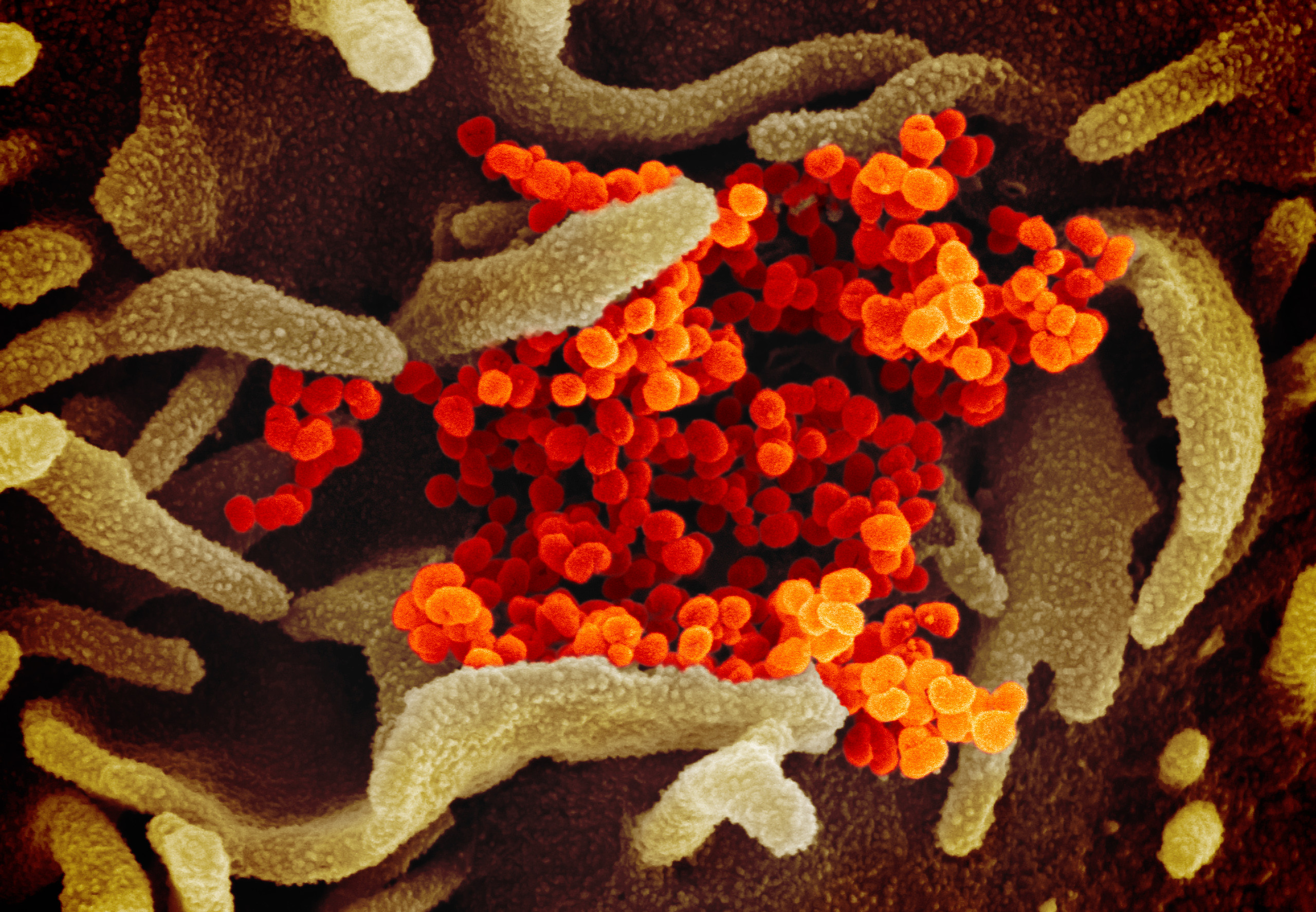 Le virus Sars-CoV-2 photographié au microscope électronique à balayage. Les couleurs ont été ajoutées par ordinateur. Les virions apparaissent en orange. © Niaid-RML