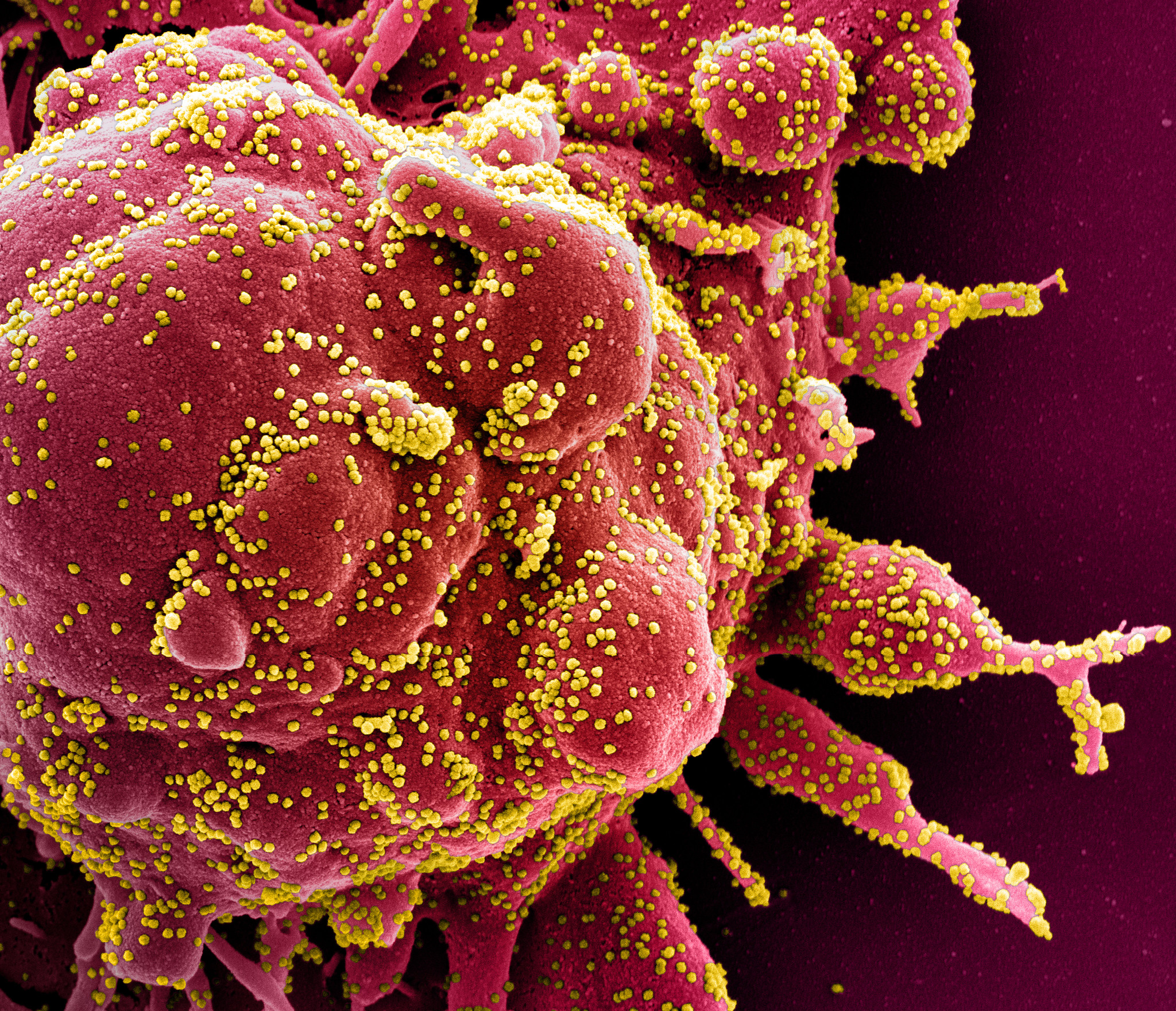 Une cellule (en rouge) infectée par le SARS-CoV-2 (particules jaunes). © NIAID
