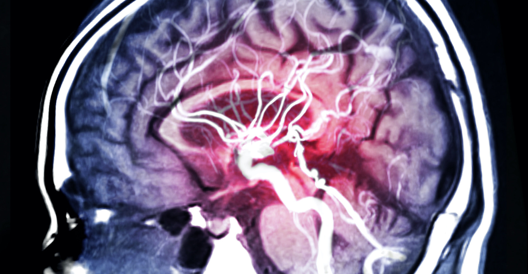 Une angiographie cérébrale est un examen radiologique qui permet d'identifier la cause d'une hémorragie méningée. ©&nbsp;samunella, Adobe Stock