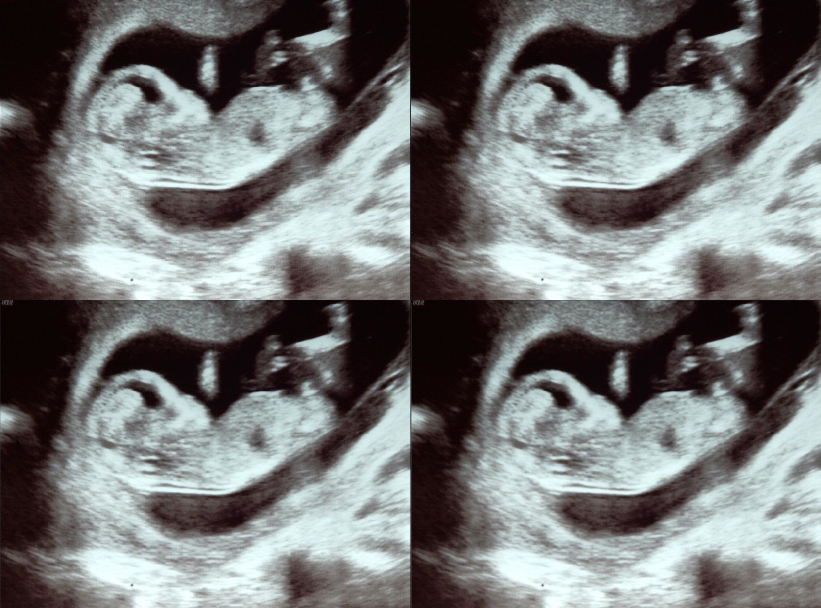 Une grossesse simultanée de deux paires de jumeaux ! © Rowen Atkinson, Flickr