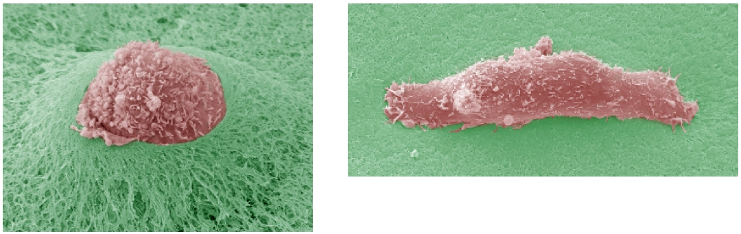 A gauche, une cellule tumorale perce une épaisseur de Matrigel, mimant la membrane basale. A droite, les protéases ont été inhibées, la cellule ne peut pas perforer la surface. © Renaud Poincloux et Philippe Chavrier/CNRS/Institut Curie