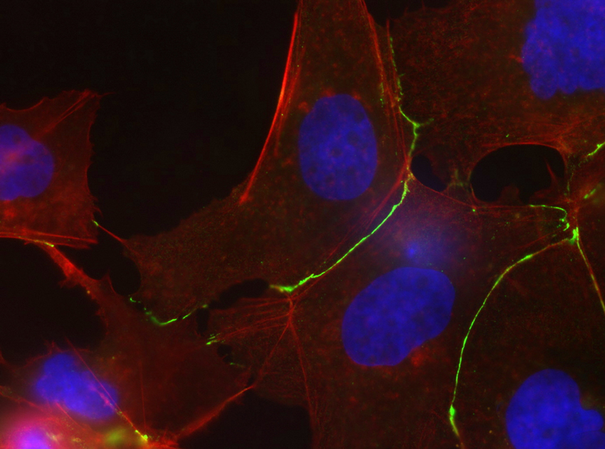 Ces cellules de lignée Hep3B sont issues d'un patient avec un cancer du foie, et déficientes en un gène :&nbsp;Hnf1a. En rouge on peut voir apparaître la N-cadhérine, en vert la phalloïdine et les noyaux sont bleus.&nbsp;© Jessica Zucman-Rossi,&nbsp;Inserm
