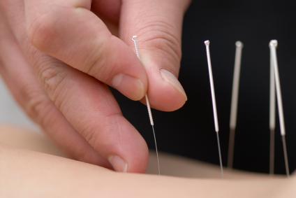 Pour soigner différents troubles, les acupuncteurs implantent des aiguilles fines à des endroits précis du corps. © DR