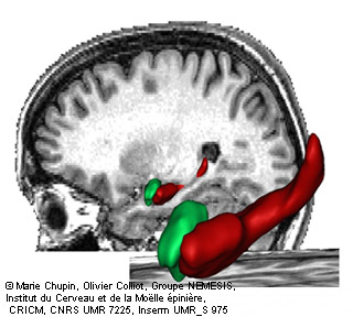 L’hippocampe est l’une des régions du cerveau les plus précocement atteintes par la maladie d’Alzheimer. L’imagerie par résonance magnétique (IRM) permet de visualiser et de délimiter cette structure in vivo. © Inserm