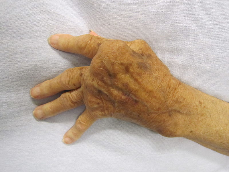 La polyarthrite rhumatoïde provoque une déformation des articulations. © James Heilman, Wikimedia, CC by-sa 3.0