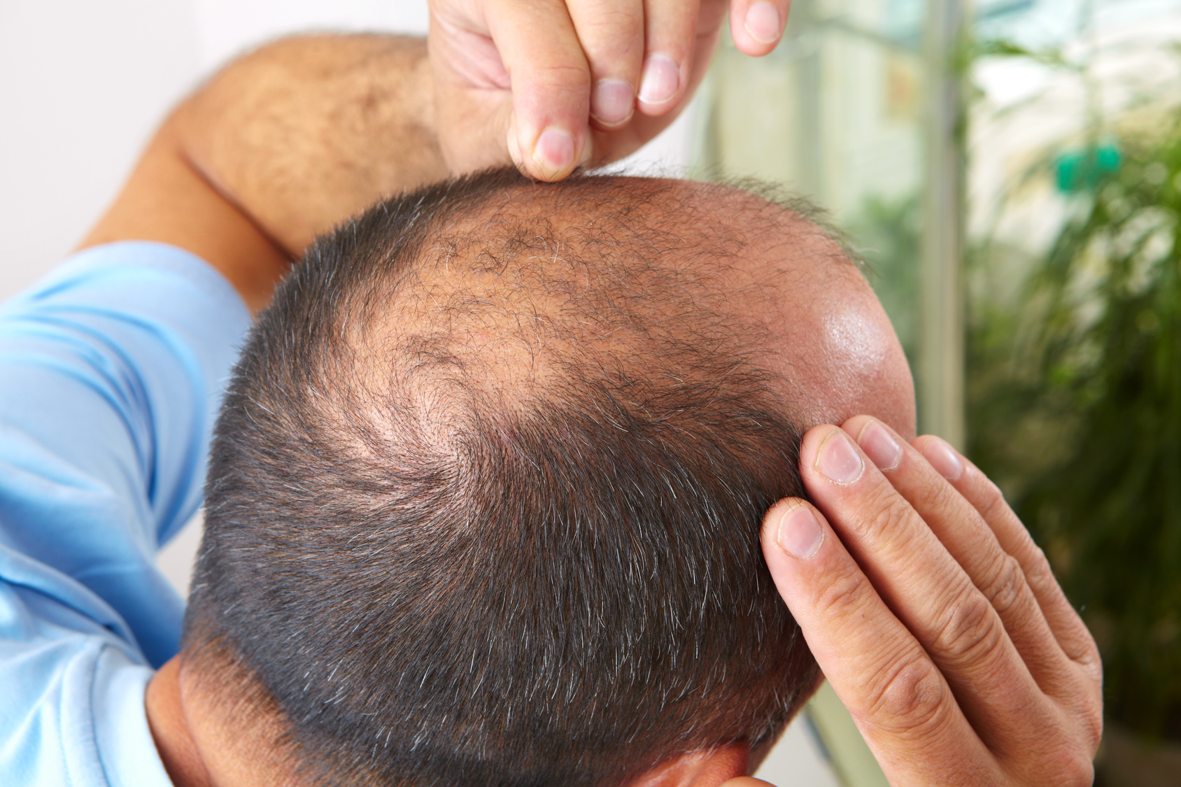 Celles et ceux qui vivent mal la perte de leurs cheveux vont peut-être retrouver un peu d’espoir grâce à des travaux de chercheurs britanniques. Ceux-ci proposent de traiter la calvitie à l’aide de médicaments anti-ostéoporoses. © Petrik, Fotolia