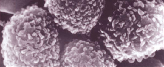 La leucémie est un cancer des cellules de la moelle osseuse vouées à rejoindre la circulation sanguine une fois arrivée à maturation. La leucémie aiguë&nbsp;lymphoblastique concerne très majoritairement une multiplication anormale de lymphocytes B ou précurseurs inactifs qui, en l'absence de traitements, vont s'accumuler dans l'organisme. La reprogrammation génique des lymphocytes T à partir du VIH pourrait en venir à bout.&nbsp;© DR