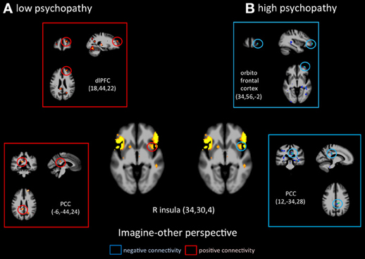 Comparaison de l’activité cérébrale d’une personne faiblement psychopathe (à gauche) et plus hautement psychopathe (à droite), en imaginant la souffrance d’autrui.&nbsp;© Decety, Chen, Harenski and Kiehl, &nbsp;Frontiers in Human Neuroscience, cc by sa 3.0, 2013