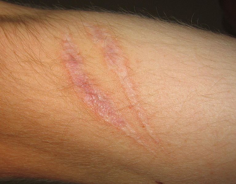 Les cicatrices sont les traces de la réparation d'une blessure par les cellules spécialisées, les fibroblastes. © Svdmolen - Creative Commons (by-nc-sa 3.0)