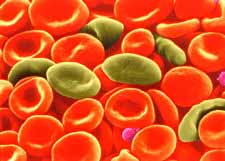 Crédits :  INSERM .Codocytes (cellules en casque, en cloche) examinés sur frottis sanguin au microscope à balayage. Ce sont des erythrocytes pathologiques. On les rencontre dans les thalassémies.