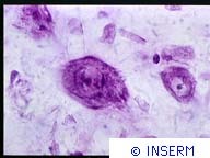 Neurones embryonnaires greffés dans le thalamus d'un rat adulte depuis deux mois. Coloration au violet de crésyl. Parkinson.Crédits : INSERM