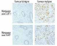 Comparaison de deux marqueurs tumoraux La présence du complexe CAF-1 ou de Ki-67, le marqueur tumoral utilisé en routine, est visualisée en marron sur les coupes de tissus. Dans les deux cas, seuls les tissus issus de tumeurs malignes sont marqués. Des an