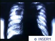 Radiographie du cancer du poumon, il s'agit d'une radiographie classique utilisant uniquement les rayons X et montrant un tumeur (tache noire sur le poumon droit).Crédit : INSERM