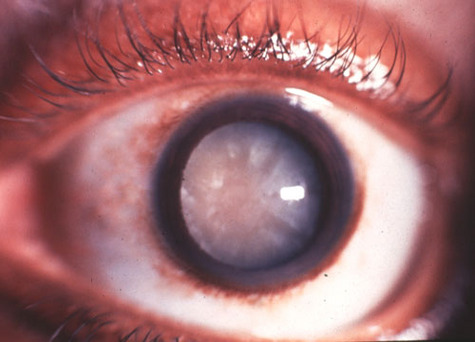Oeil atteint de cataracte