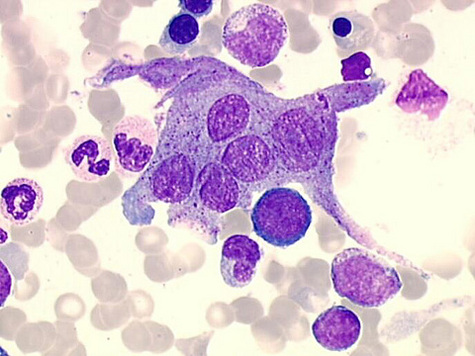 Ostéoclaste.Cette cellule est en fait un histiocyte macrophage spécialisé dans la résorption osseuse : le contenu en granulations varie d'une cellule à l'autre.Crédits : www.med.univ-angers.fr